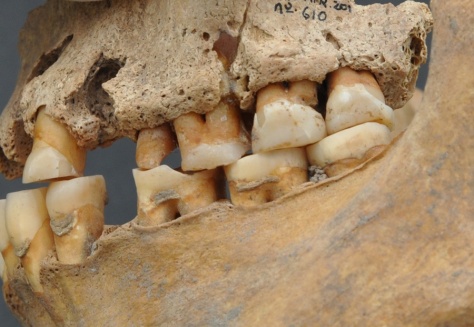 This individual suffered severe dental wear and a variety of oral pathologies - IPHES